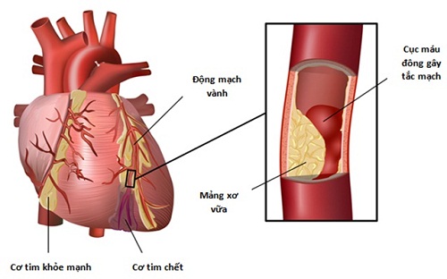 Nguyên nhân gây ra bệnh tim mạch