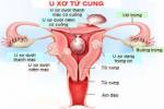 Thuốc chữa Hiếm muộn do u xơ tử cung