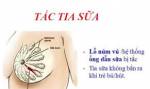 Bài thuốc trị viêm mủ cấp Tuyến vú ( Tắc sữa)