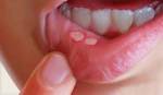 Bài thuốc trị nhiệt miệng