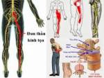 Bài thuốc trị đau dây thần kinh tọa